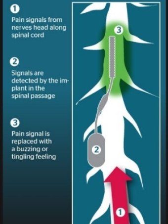 Patient fitted with spinal cord stimulator to treat chronic pain