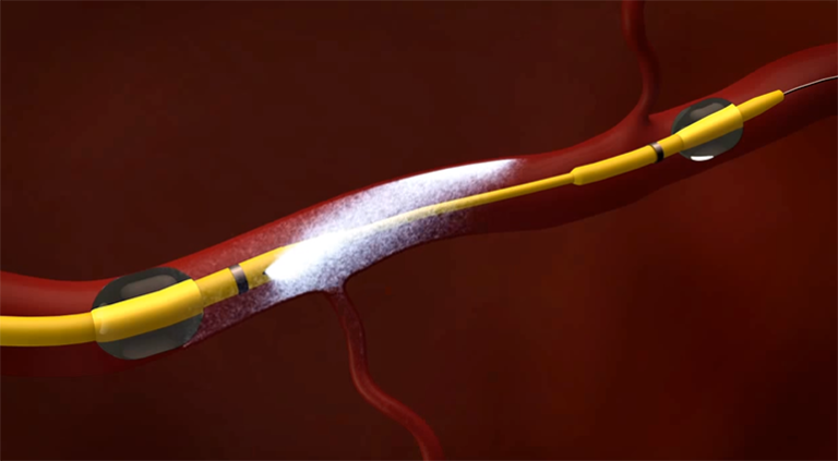 RenovoCath for Targeted Fluid Delivery Into Peripheral Vasculature Cleared in Europe