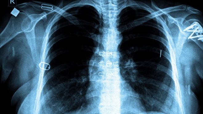 Lungs with tuberculosis