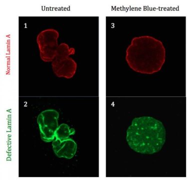 Safe, inexpensive chemical found to reverse symptoms of progeria in human cells