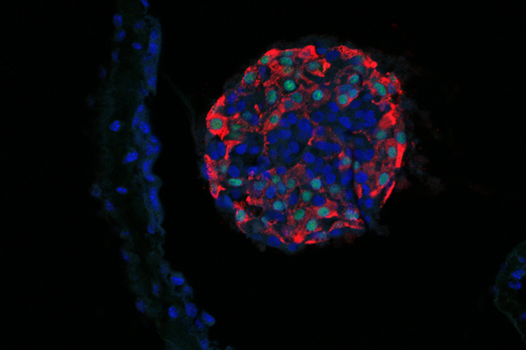 Breakthrough for Diabetes: Material Protects Transplanted Pancreatic Islet Cells from Immune System