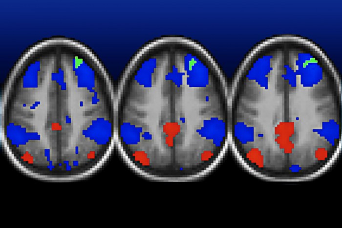 Functional MRI scans show areas in the brains of poor children with normal connectivity highlighted in red and blue, and weakened connectivity shown in green. The areas in green are among several areas — detailed in other brain scans — where connections are weakened in children raised in poverty. (Image: Washington University School of Medicine)