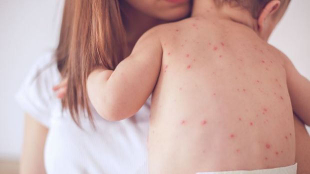 Doctor fears hidden measles threat after Melbourne anti-vaxer seeks covert help for her infected child