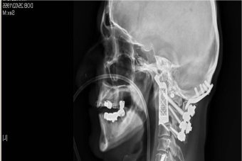 Tumour patient gets world’s first 3D-printed vertebrae