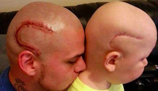 Awesome dad gets a tattoo of his son’s cancer surgery scar