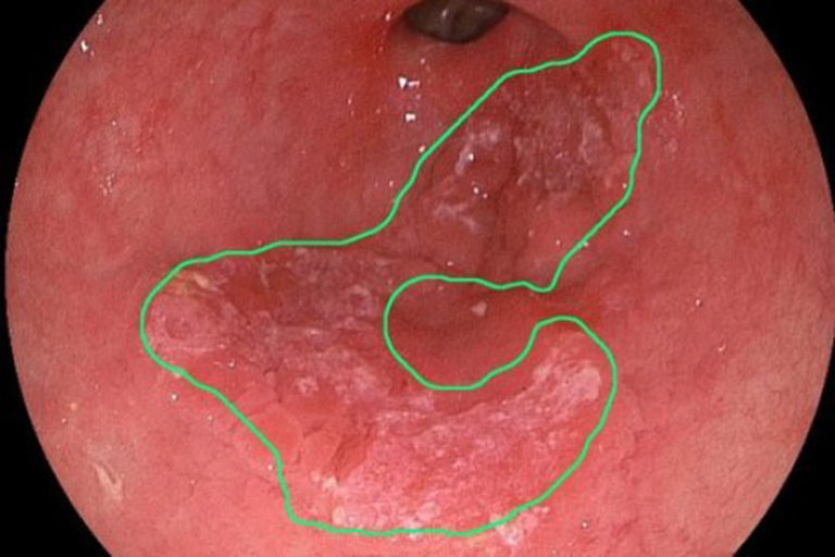 Automatic Computer Vision System Detects Early Esophageal Cancer