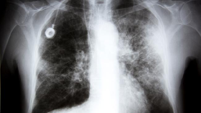 Breakthrough lung cancer drug discovery