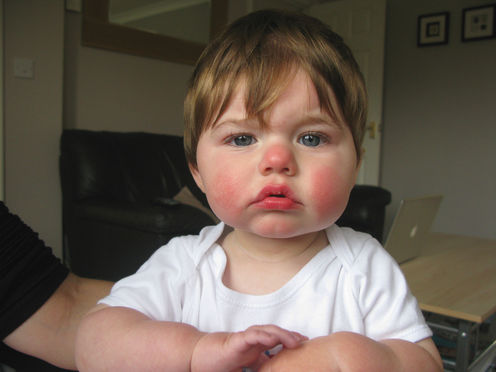 ‘Slapped cheek’ syndrome: a common rash in kids, more sinister in pregnant women