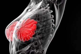 Breast density study targets cancer link and prevention