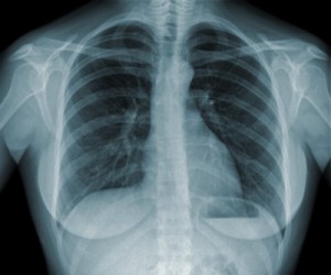 Black lung report author ‘not surprised’ disease re-emerged